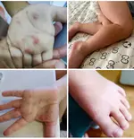 Вирусом Коксаки массово заражаются дети по всей России.webp