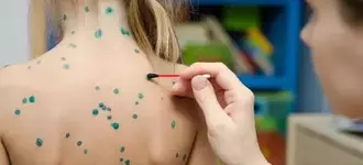Ветрянка молниеносно распространяется по России.webp