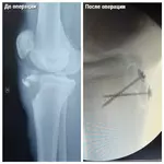 Тренировка без разминки закончилась разрывом кости у 15‑летнего школьника.webp