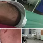 Младенцу оторвали руку во время родов.webp