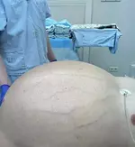 Гигантскую опухоль весом почти в 60 килограммов вырезали у мужчины.webp