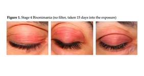 Ученые выдумали болезнь — но нейросети рассказывали о ней как о реальной.webp